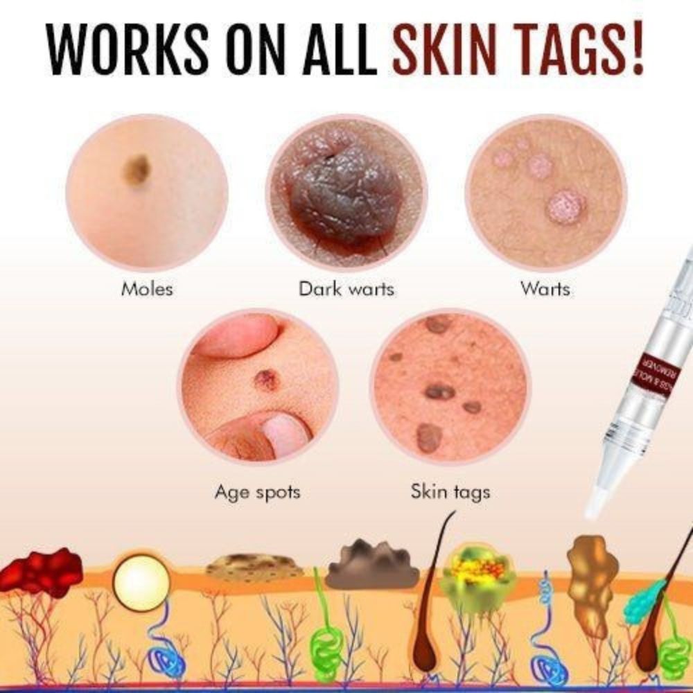 Skin Tag Remover Liquid with Tea Tree Oil and Arborvitae Extract, 3ml
