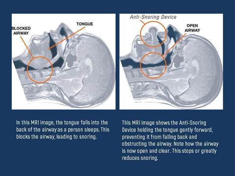 Tongue Stabilizing Device with Medical Silicone and Suction Technology for Sleep