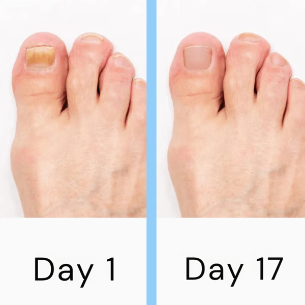 LED Nail Therapy Device with Dual Wavelength Light and Seven Minute Sessions