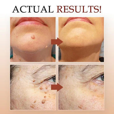 Skin Tag Remover Liquid with Tea Tree Oil and Arborvitae Extract, 3ml