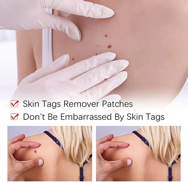 Skin Tag Remover Liquid with Tea Tree Oil and Arborvitae Extract, 3ml