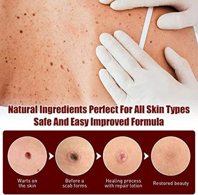 Skin Tag Remover Liquid with Tea Tree Oil and Arborvitae Extract, 3ml